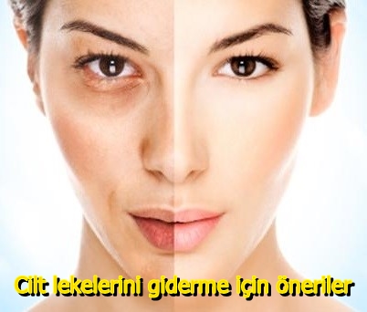 Cilt lekelerini giderme için öneriler - http://eskort-istanbul.com/
